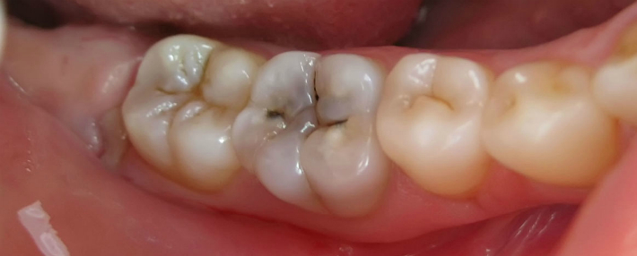 Предпоследний зуб кроме чёрных ямок на жевательной поверхности имеет потемневшую область в центре зуба. Это так называемая "тень" кариеса, которая указывает, что под неразрушенными поверхностными тканями зуба уже есть распространившийся кариозный процесс