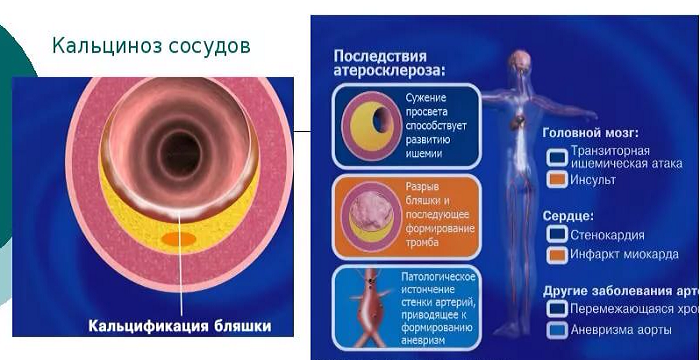 Кальцинаты в стенках аорты. Отложение кальция в сосудах. Кальциноз атеросклеротической бляшки артерий. Кальцификация коронарных артерий.