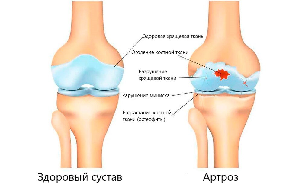Фото источник https://clinica-paramita.ru/info/artroz/. Суставная деформация при артрозе
