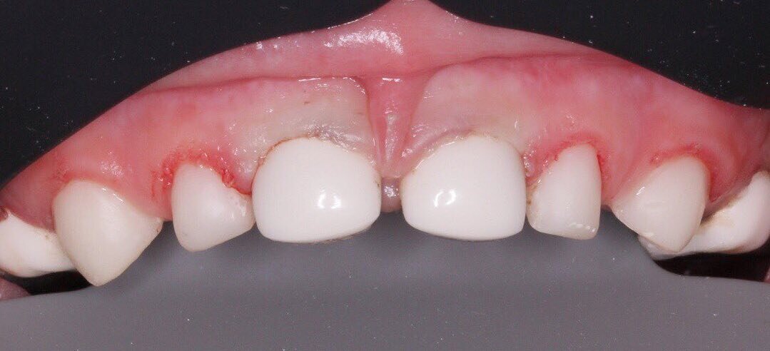 Десна сразу после установки коронок