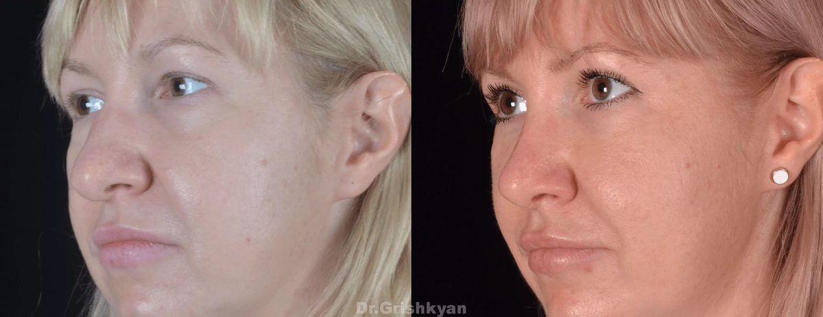Ринопластика толстого кончика носа фото до и после. Фото с сайта Д.Р. Гришкяна. Имеются противопоказания, требуется консультация специалиста