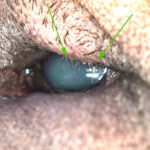 Заворот верхнего века привел к появлению эрозии роговицы и болевому синдрому.Завёрнутое верхнее веко натёрло язву роговицы. Есть болевой синдром.
