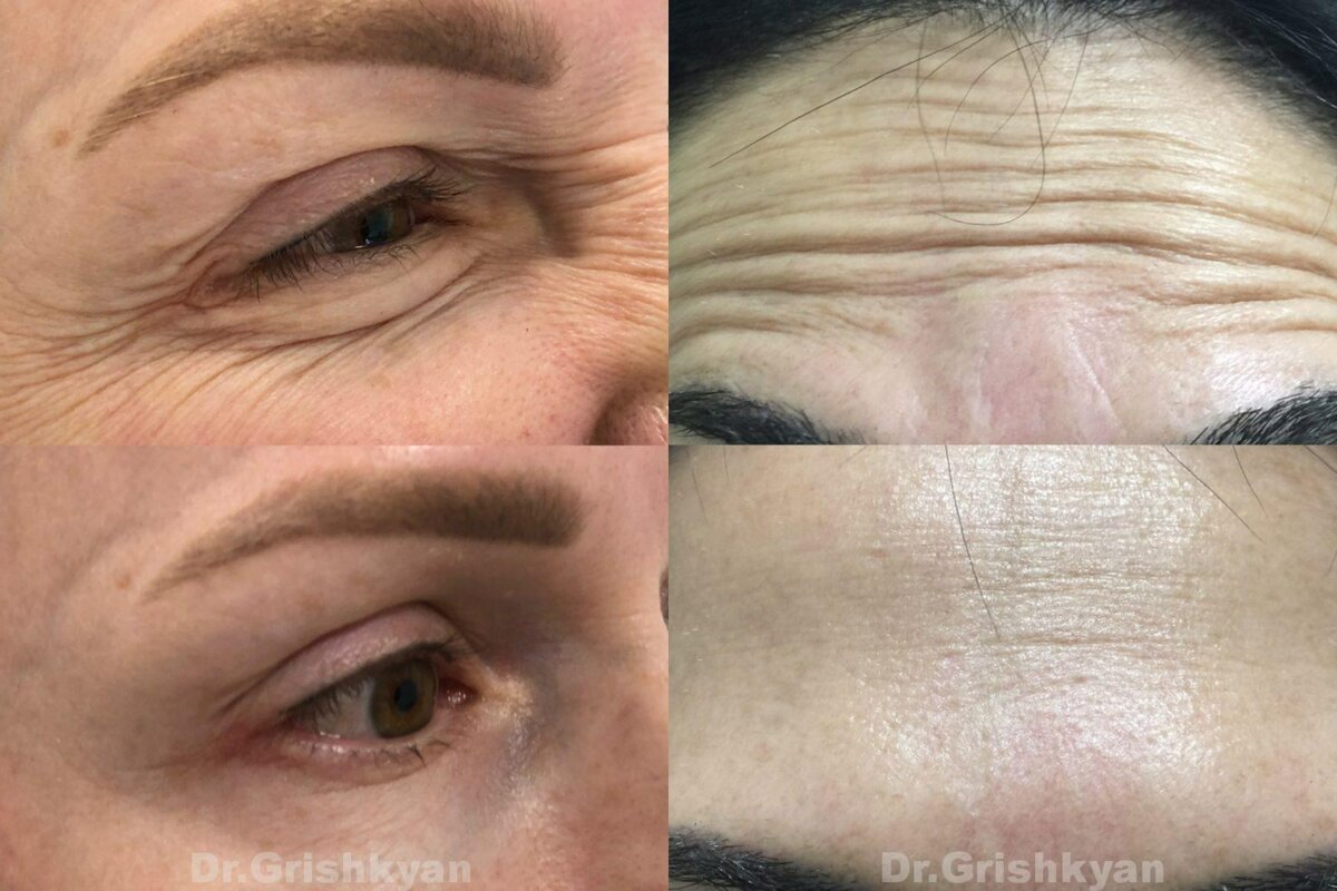 Инъекции ботулотоксина фото до и после процедуры. Фото с сайта Д.Р. Гришкяна. Имеются противопоказания, требуется консультация специалиста