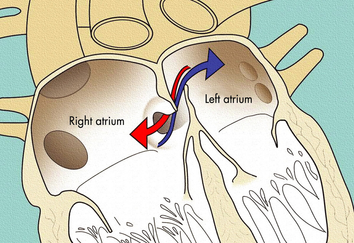 Foramen ovale сердце