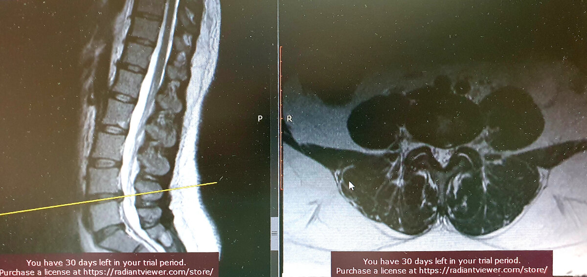 Грыжа L4-L5, с преобладающим сужением фораминального отверстия слева.