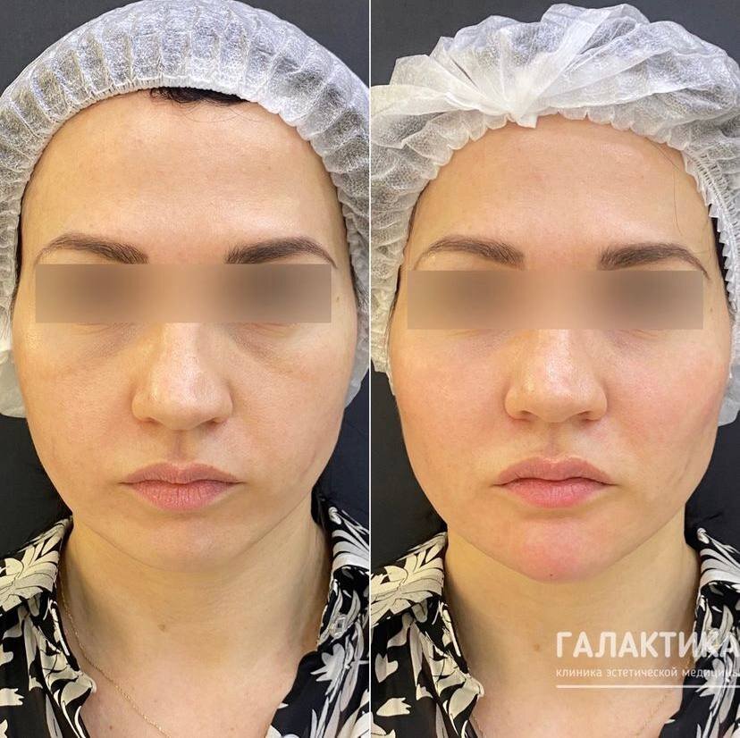 Коррекция средней и нижней трети лица препаратом Radiesse, результат сразу после процедуры.