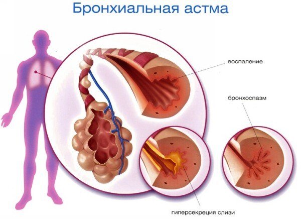 Как можно снять бронхоспазм Бронхиальная астма - что делать? Полезные советы для жизни Дзен