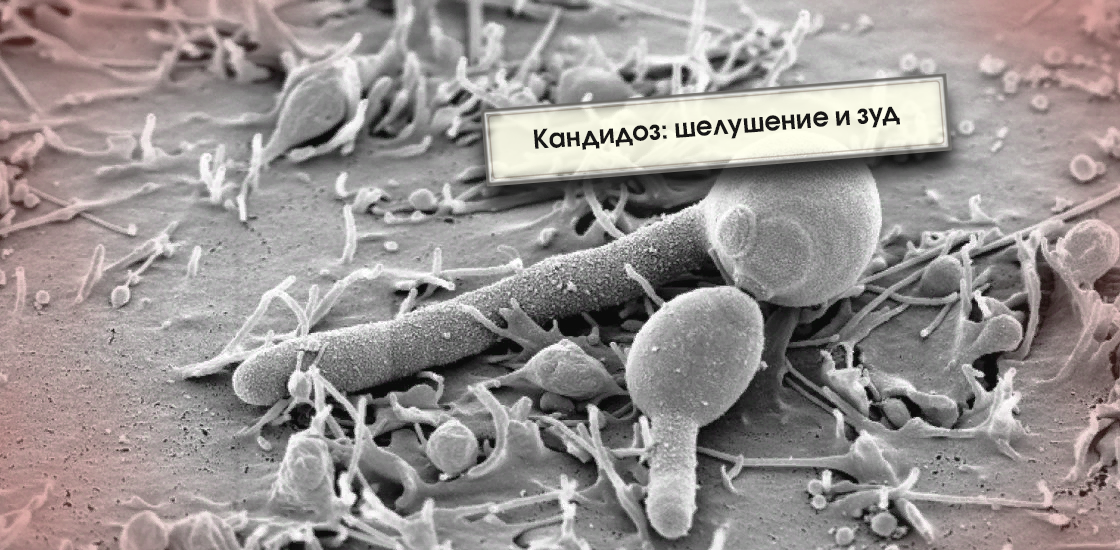 Бактериальный вагиноз (Дисбактериоз влагалища, Гарднереллёз, Bacterial vaginosis)