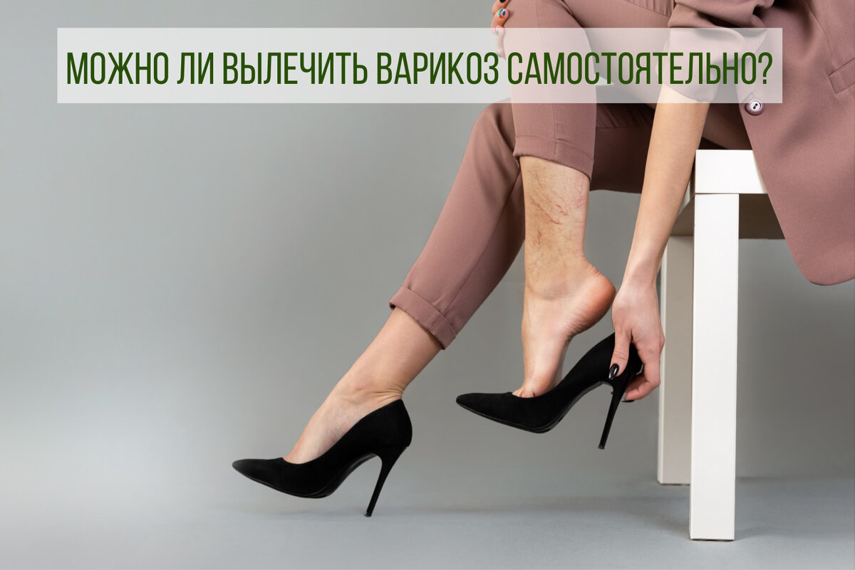 Можно ли вылечить варикоз самостоятельно? | Эскузан | Дзен