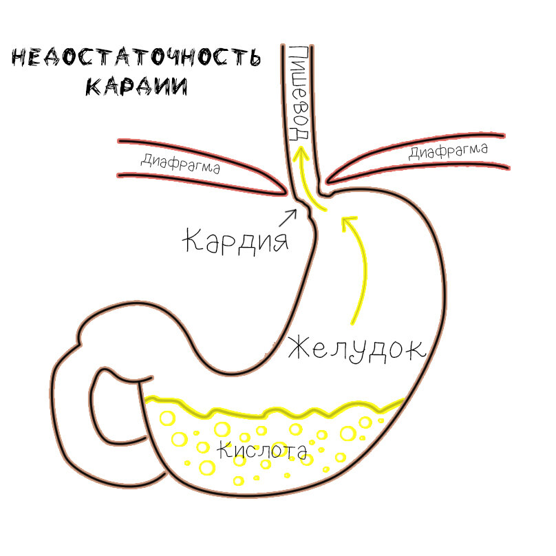 Кардия желудка 2 степени