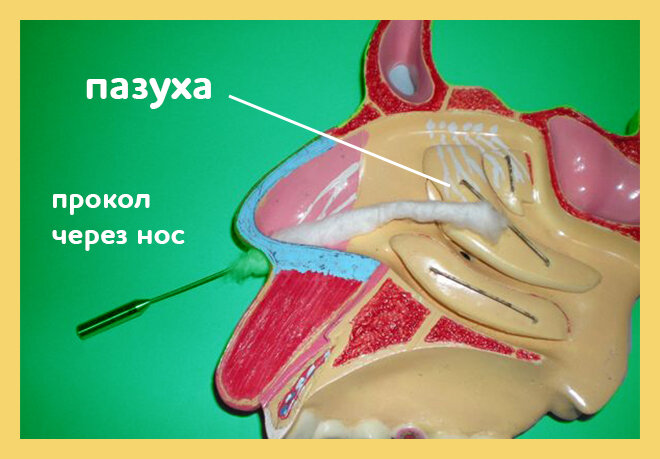 Cхематичное изображение прокола