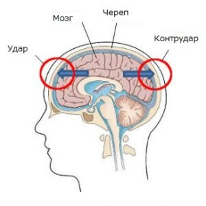 Ведение пациента, перенесшего сотрясение головного мозга