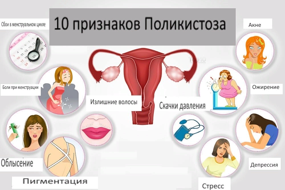 Пкя. Синдром поликистоза яичников симптомы. Поликистоз яичников симптомы. Поликистоз яичников симп. Симптомы поликистоза яичников