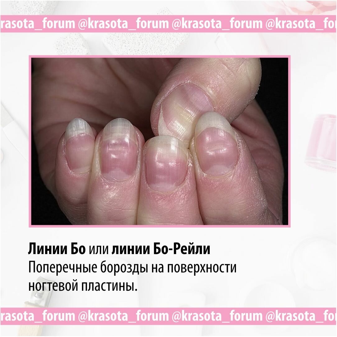 Продольные борозды на ногтях рук и ног – симптомы, причины, лечение и профилактика