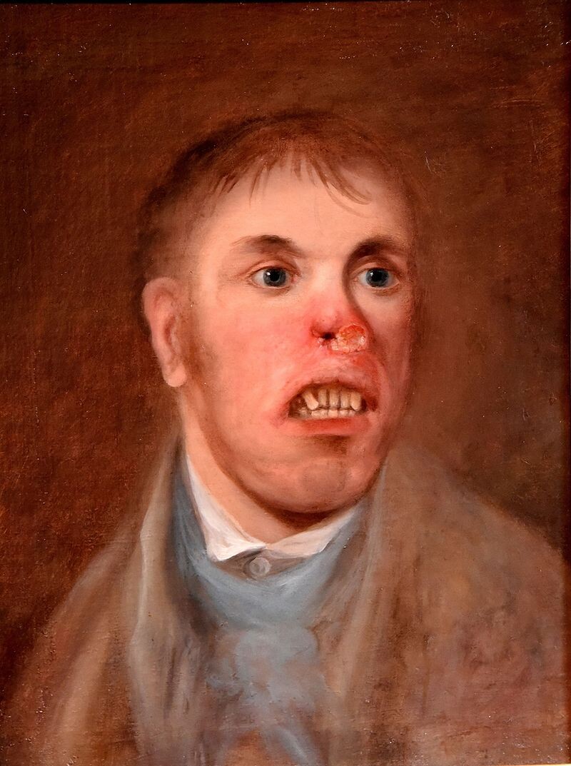 Портрет Д. Кея, больного сифилисом. Неизвестный художник. Ок. 1820 г.