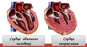 Брадикардия — Википедия