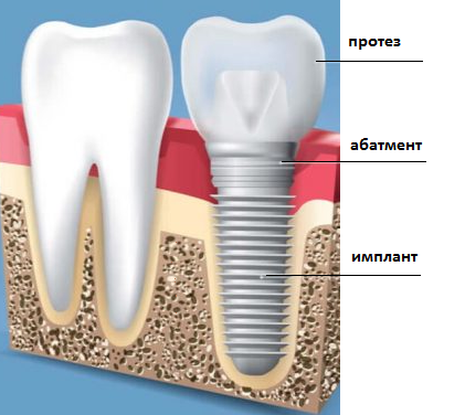 Скриншот конструкции протеза в разрезе