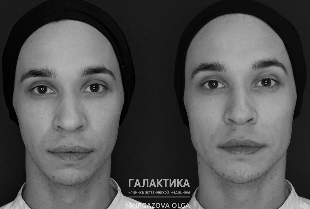 Результат контурной пластики препаратом Neauvia MAN