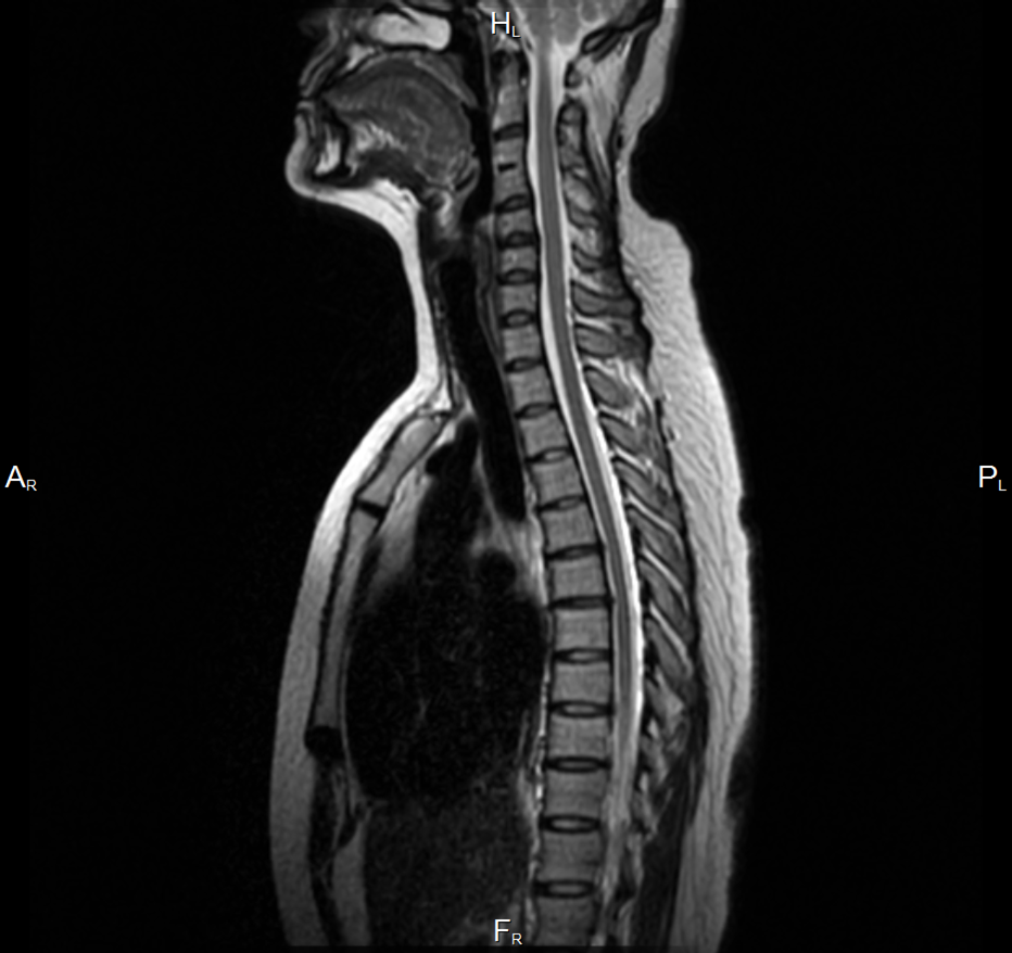Грудной отдел фото. Мрт грудного отдела позвоночника. Мрт грудного отдела позвоночника норма. Мрт спинного мозга грудной отдел. Мрт спинной мозг отдел позвоночника.