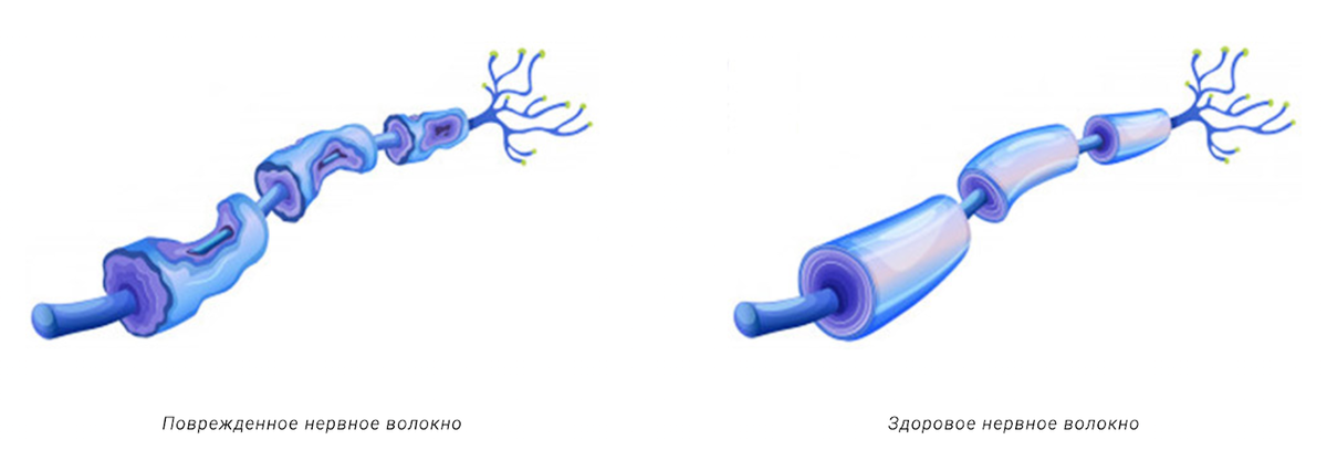 Повреждение нервного волокна выглядит примерно так