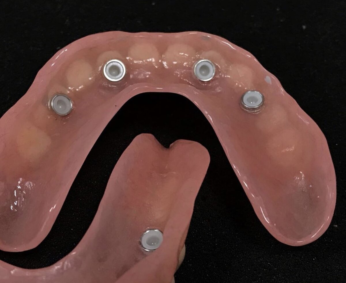 НА ФОТО: ВИЛ ПРОТЕЗА ЛОКАТОР СО СТОРОНЫ ПРИЛЕГАЮЩЕЙ К ЗУБАМ
