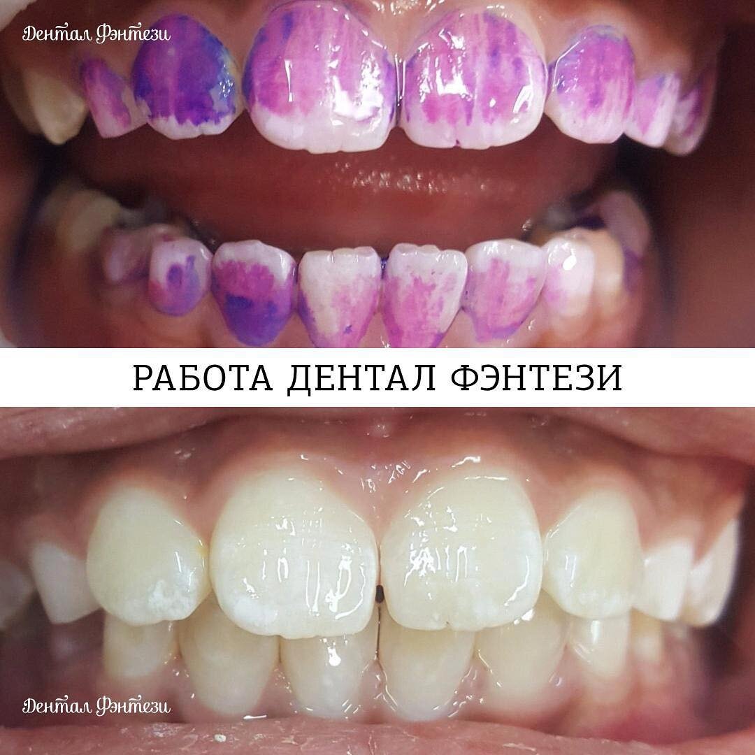 С индикатором налета и после чистки. Источник https://www.instagram.com/dental.fantasy/ 