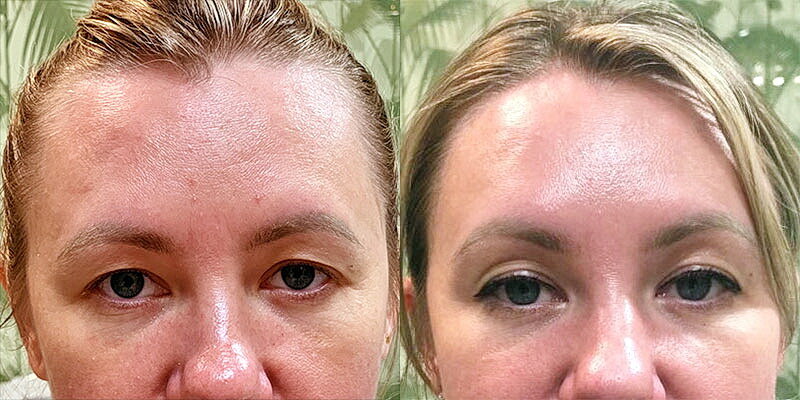 До и после одного сеанса процедуры холодной плазмы