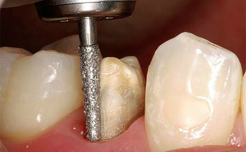 Как ставят коронку на зуб и больно ли это?