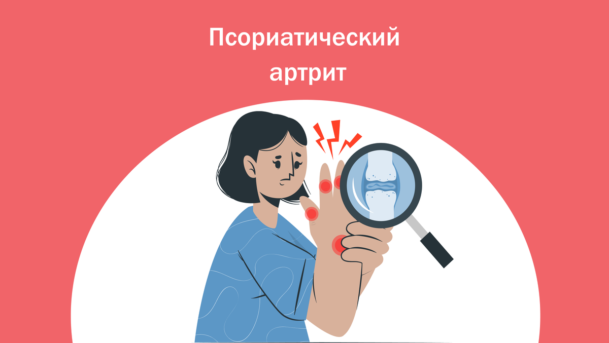 Псориатический артрит: как выявить и остановить развитие патологии ...
