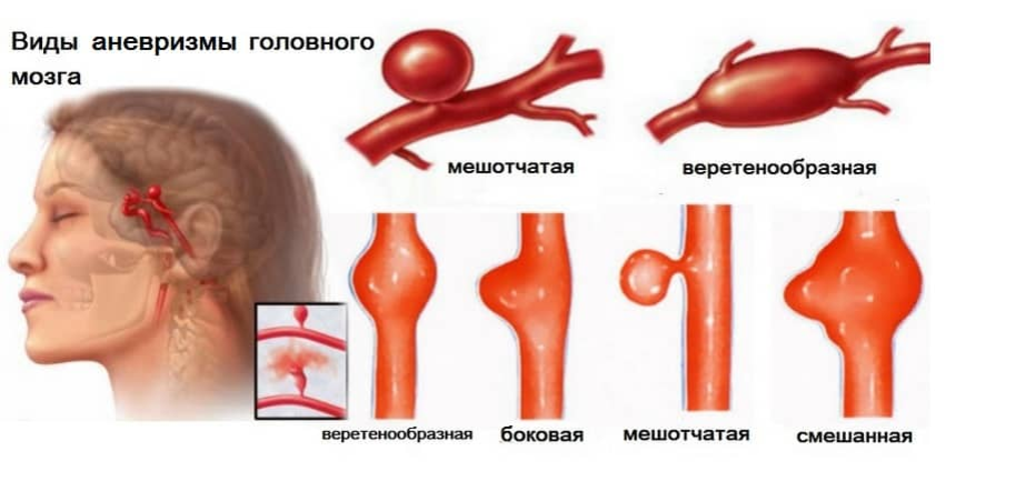 Аневризма сосудов