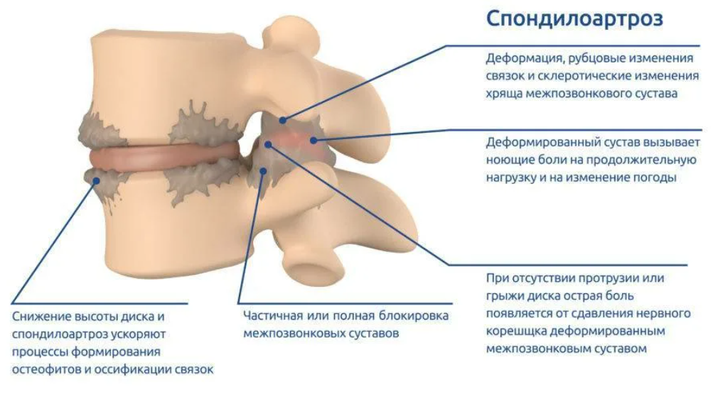 Гипертрофия суставных. Остеоартроз дугоотросчатых суставов шейного отдела. Дугоотросчатые суставы позвоночника. Спондилоартроз поясничного отдела позвоночника что это такое. Дугоотросчатые суставы позвоночника классификация.