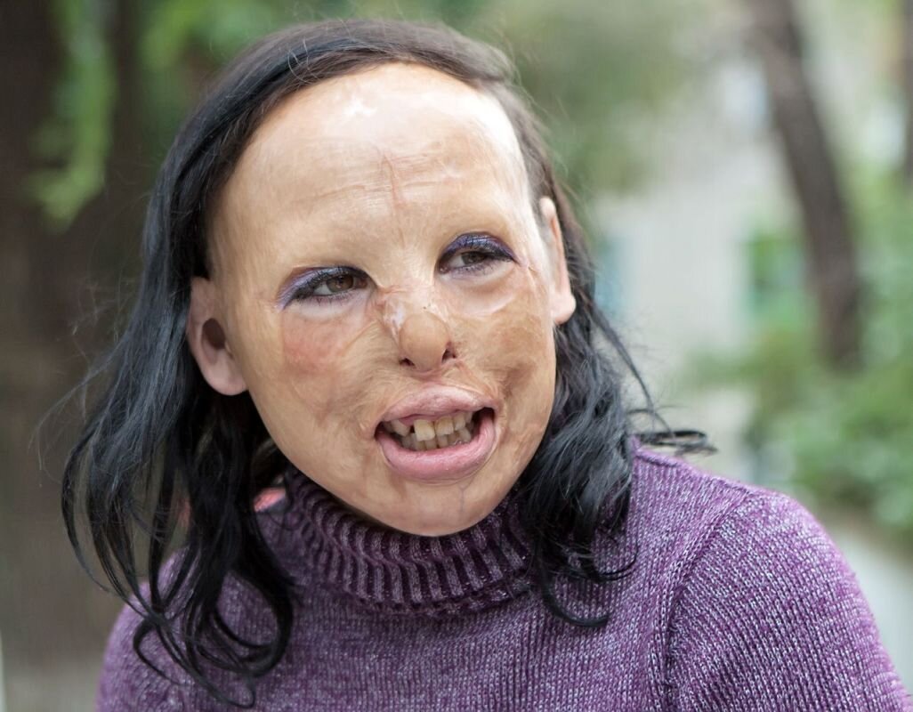    фото Александра ЗИНЧЕНКО. Так Аня выглядела до операции