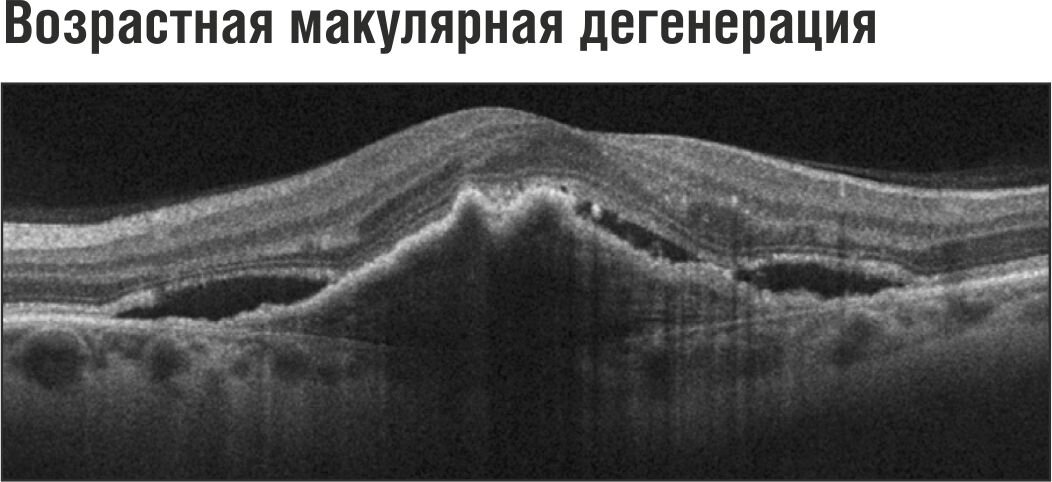 Очаговая дегенерация. Окт макулодистрофия сухая. Дегенерация сетчатки глаза. Неоваскулярная макулодистрофия. Возрастная макулярная дистрофия на окт.
