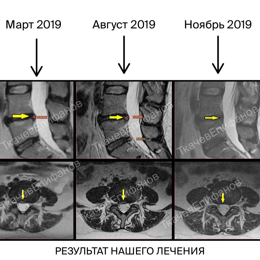Дисков в сегменте l4 l5. Доктор для диск грыжа в город Душанбе. Диск грыжа Новосибирский массаж где есть Алиса