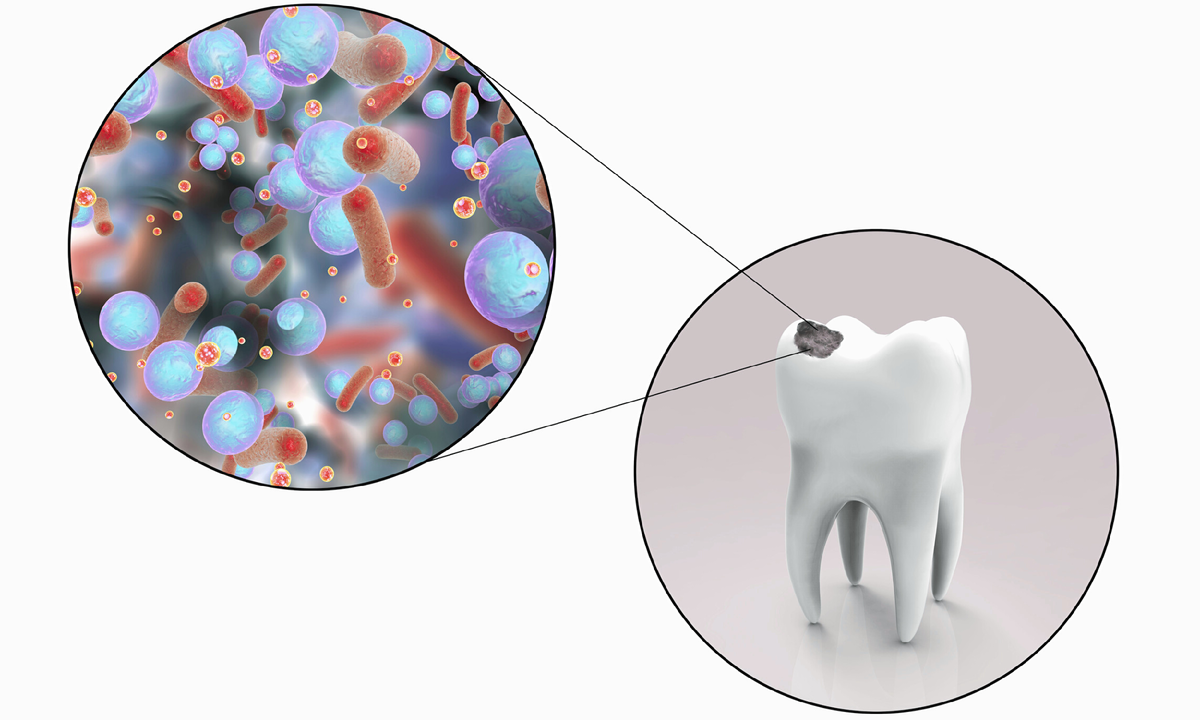 Кариозное пятно.