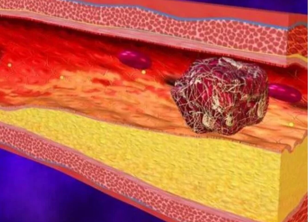 Тромб в венах