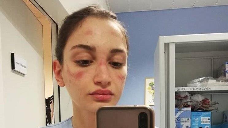 Итальянская медсестра Мартина Бенедетти стала знаменитой после публикации фото со следами маски на своём лице. Фото litirreno.gelocal.it
