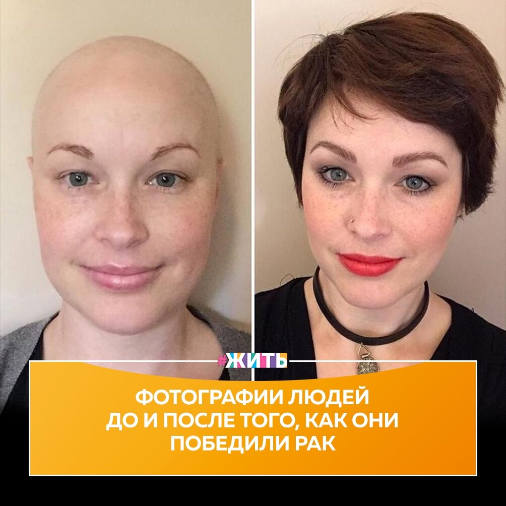 Все мы знаем, что победить рак – задача не из простых. Но есть вещь посильнее рака – это мужество и сила людей, которые с ним борются💪 
Некоторые люди из нашей подборки победили рак еще в детстве, другие были взрослыми. Некоторым давали несколько месяцев, другим вообще не давали шансов на выздоровление. Но эти люди никогда не сдавались: великая сила человеческого духа✊

Мы хотим поделать добра и счастья им. Поддержим этих прекрасных и сильных людей в комментариях🤲

#жить #проектжить