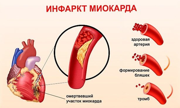 https://sosudy.info/ostryj-infarkt-miokarda