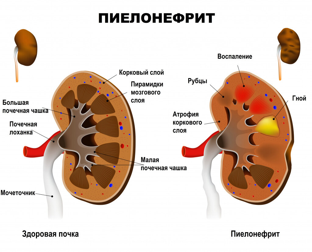 Пиелонефрит у детей | Доктор Молодой | Дзен