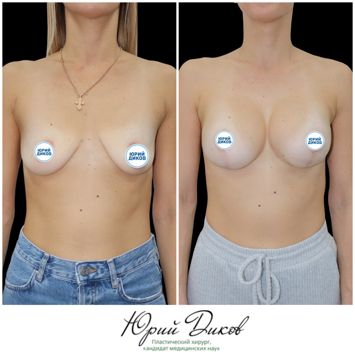 импланты для груди третьего размера фото 58