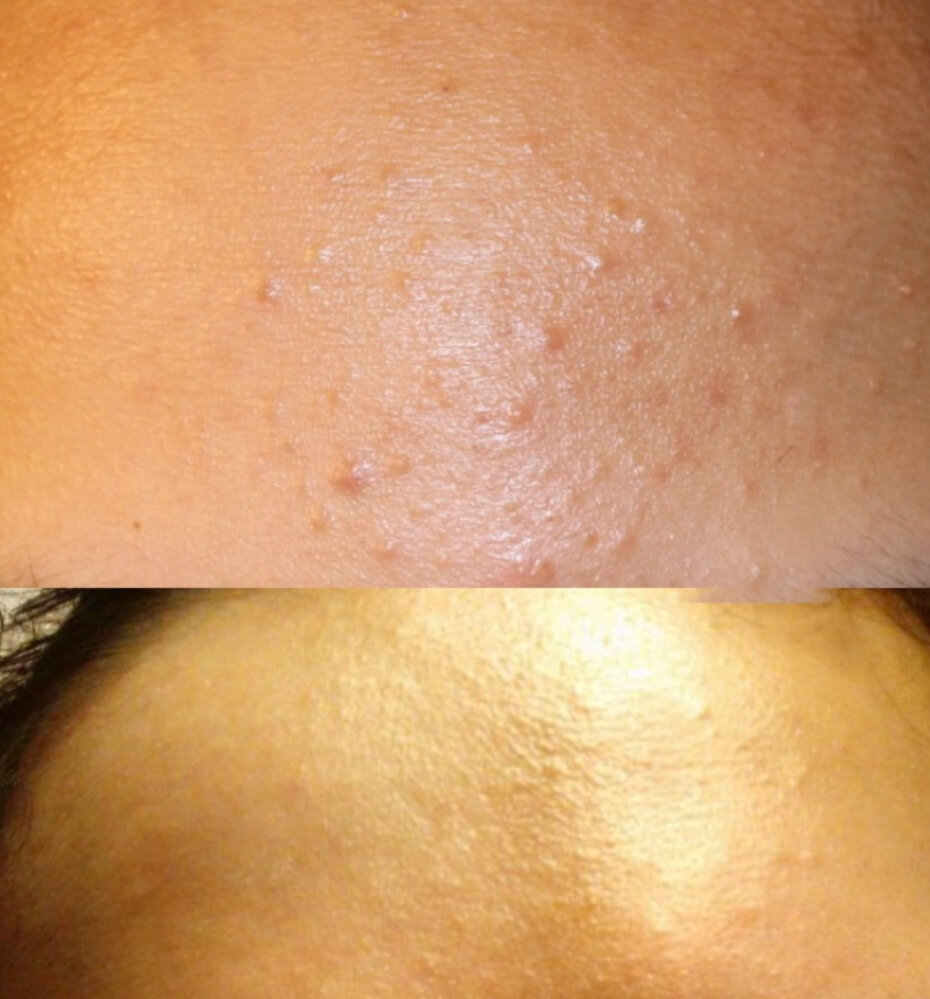 Результат всего за 3 недели использования сыворотки 