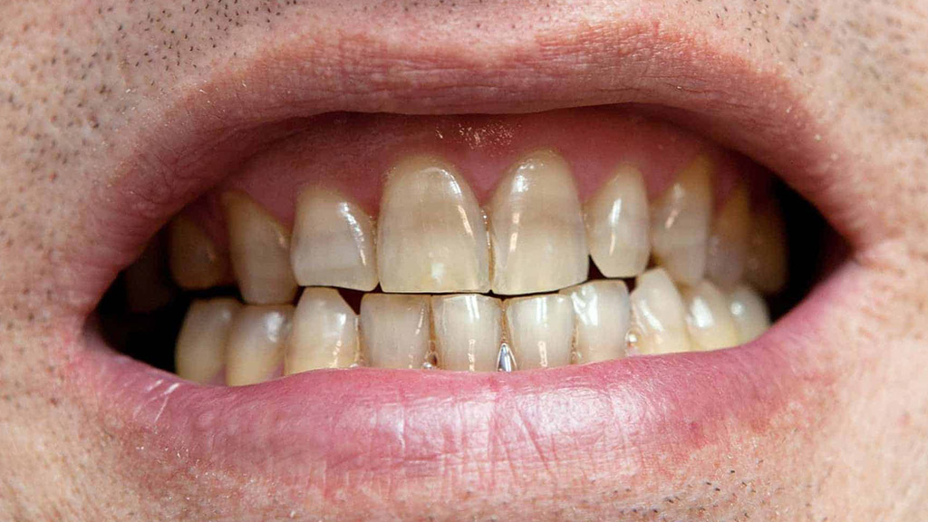 Тетрациклиновые зубы