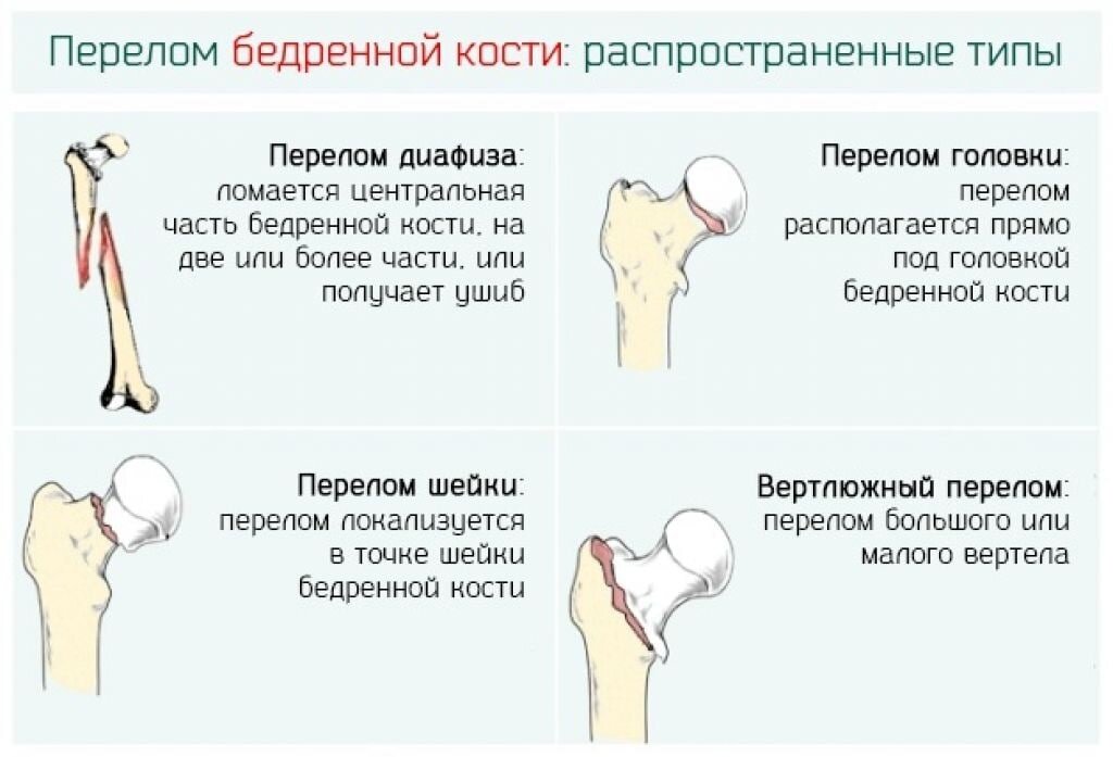 Почему ломаются кости