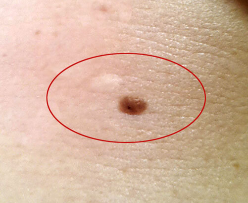Фото автора: Рядом с белым шрамом от лазерного удаления родинки  выросла новая 