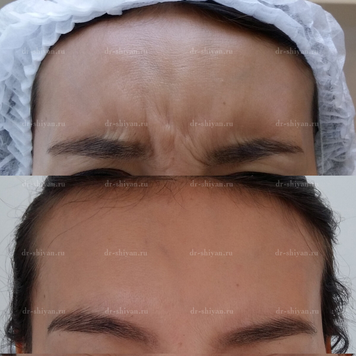 Мимические морщины на переносице - Мимические морщины - 1