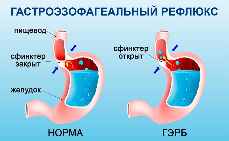 Отрыжка: причины появления и методы борьбы