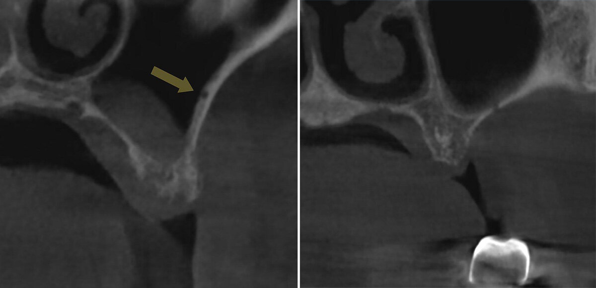 Рисунок 1. Рентгенологические признаки альвеоло-антральной артерии на коронарном реформате КЛКТ. a: вдавление в латеральной стенке верхнечелюстного синуса (стрелка);
b: прерывание стенки верхнечелюстного синуса.