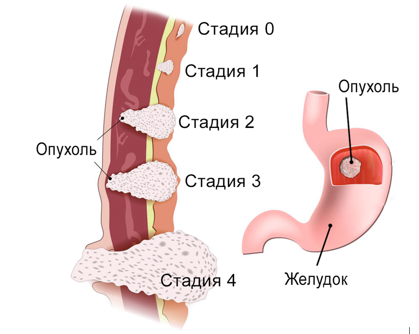 Рак желудка на первой стадии. Новообразование в желудке. Опухоль желудка стадии.
