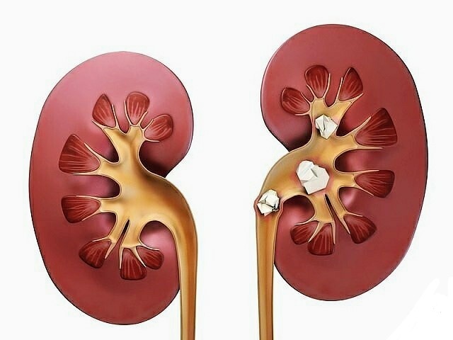 Камни в почках